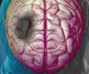 Acute Stroke Online course online (1.50 CE or 1 credit)
